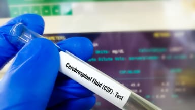 Cerebrospinale Flüssigkeit in Röhrchen