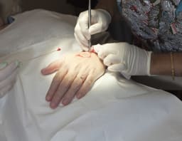 Mohs-Chirurgie an der Hand