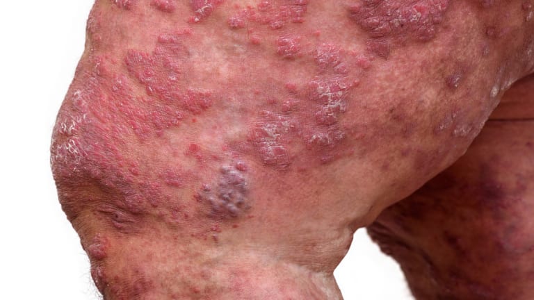 Psoriasis und Adipositas: Simultaner Therapieansatz sinnvoll?