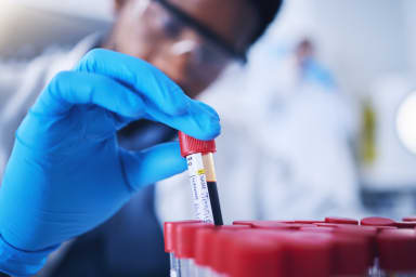 Neuer Bluttest ermöglicht Nachweis eines frühen Prostatakarzinoms in nur 15 Minuten