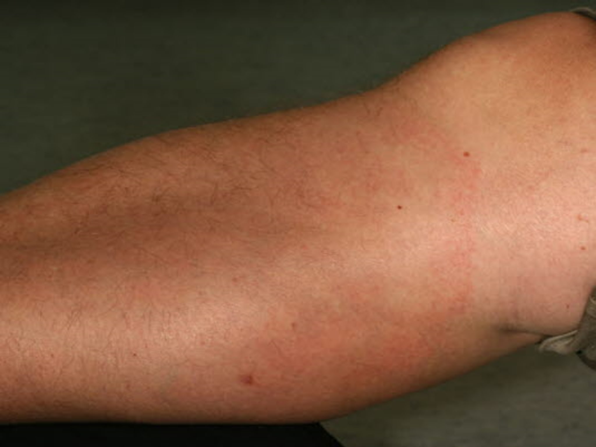 LymeBorreliose Diagnose und Behandlung coliquio