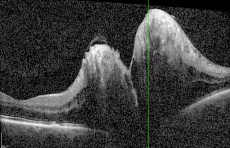 Beidseitige Papillenschwellung Abb. 2: OCT-Aufnahme des rechten Auges