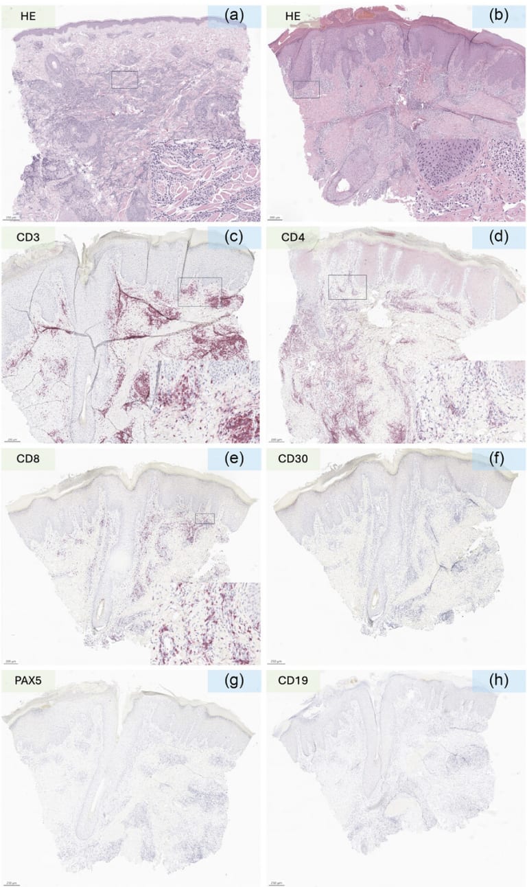 Abb. 2.: a) Hämatoxylin- und Eosin-Färbung (HE) der B-ALL-induzierten Leukaemia cutis vor der Behandlung mit Anti-CD19-CAR-T-Zellen; (b) HE-Färbung der Anti-CD19-CAR-T-induzierten kutanen Nebenwirkung; (c–f) T-Zell-spezifische Färbung (CD3, CD4, CD8, CD30) zeigt ein gemischtes CD30-negatives CD4 / CD8-Lymphozyten-Infiltrat; (g, h) PAX5- und CD19-Färbung mit nur wenigen B-Zellen in der betroffenen Haut. Maßstabsbalken = 250 μm (a, f–h) oder 200 μm (b–e), wie in der unteren linken Ecke jeder Färbung angegeben