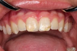 "Kreidezähne" - hier sind Vorderzähne eines Kindes betroffen