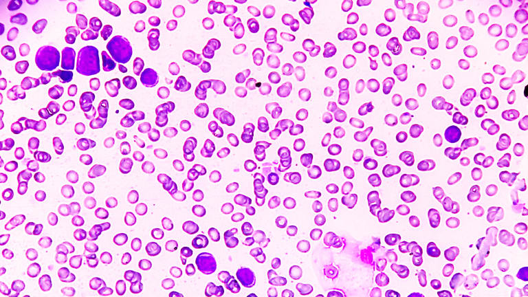 Akute myeloische Leukämie (AML), eine Form von Blutkrebs, bei der das Knochenmark abnormale Myeloblasten bildet.