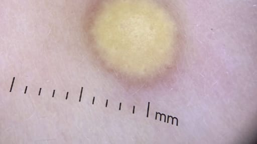 Gelbe Papel auf dem Rücken eines Säuglings Abb. 1