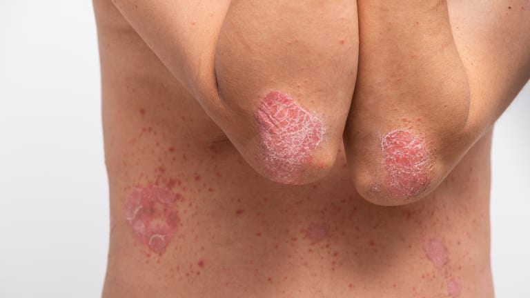 Biologika bei Psoriasis: Wann ein Wechsel sinnvoll ist