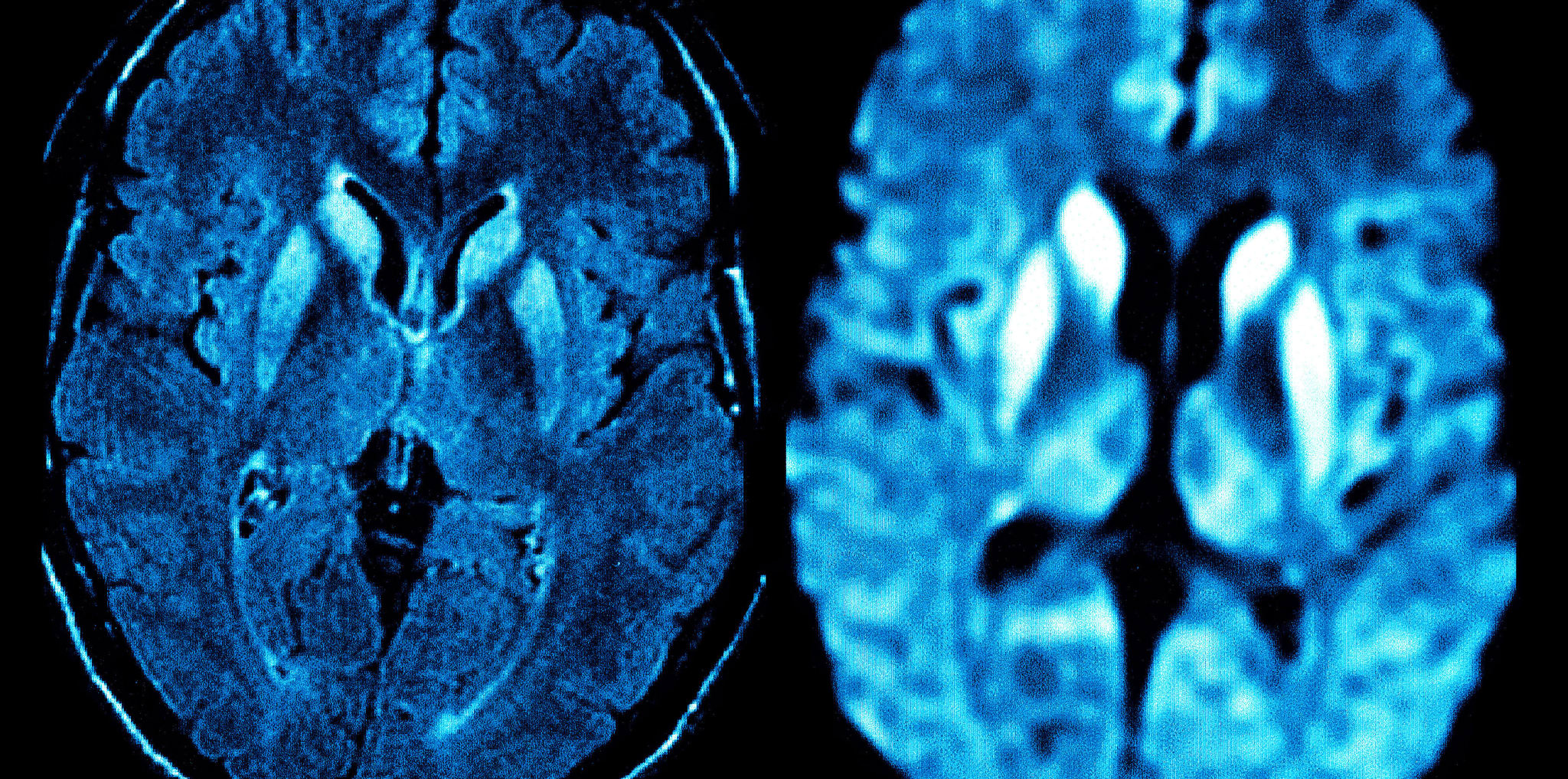 AntikörperTherapie bei PrionenErkrankung erstmals am Menschen erprobt