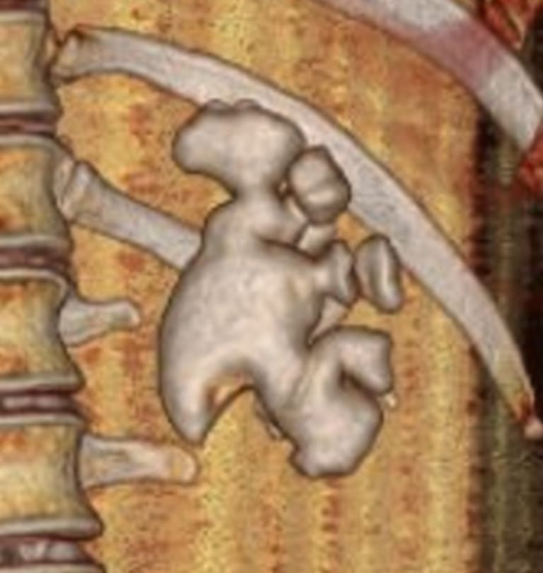 CT-3D-Rekonstruktion, die einen Hirschgeweihstein in der linken Niere zeigt