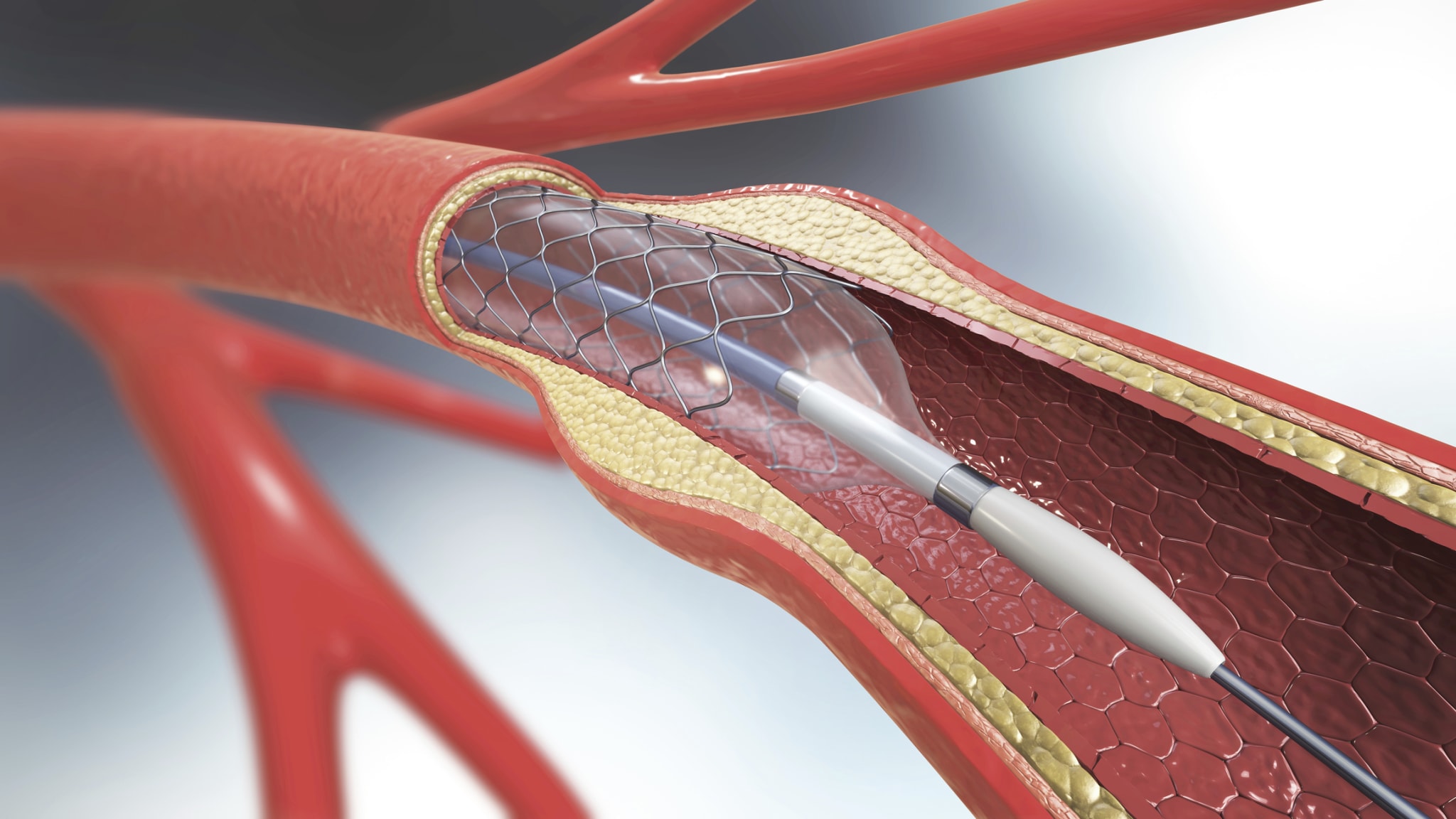 Stenose der linken Koronararterie: Stent so gut wie Bypass?