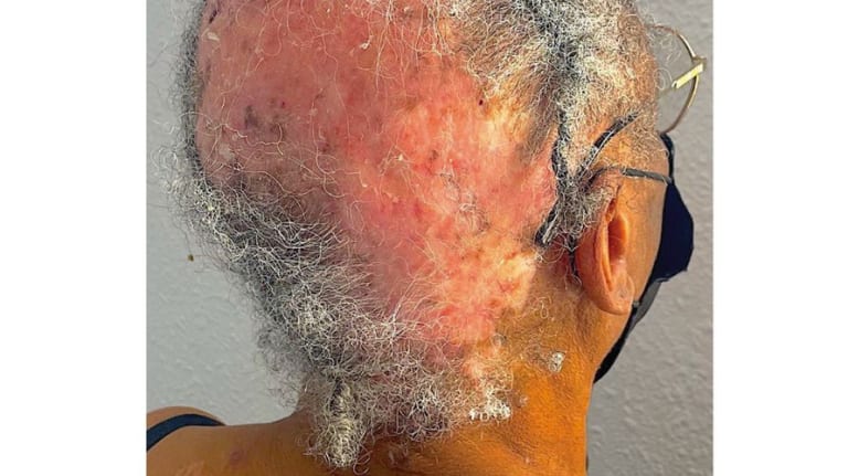 Ein extremer Fall von Lupus erythematodes 