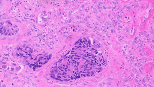 Histopathologie eines kolorektalen Adenokarzinoms