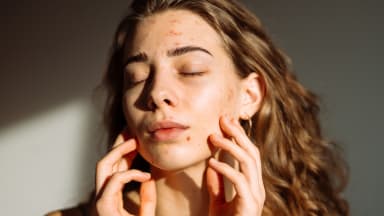 TikTok macht Akne-Mittel Isotretinoin zum Beauty-Trend gegen Pickel: eine neue Herausforderung