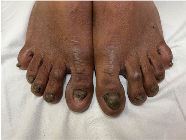 Progressive Dystrophie der Finger- und Zehennägel