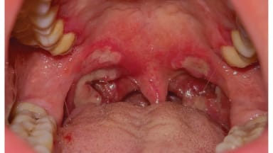 Grau-weiße Plaques im Oropharynx eines 35-Jährigen