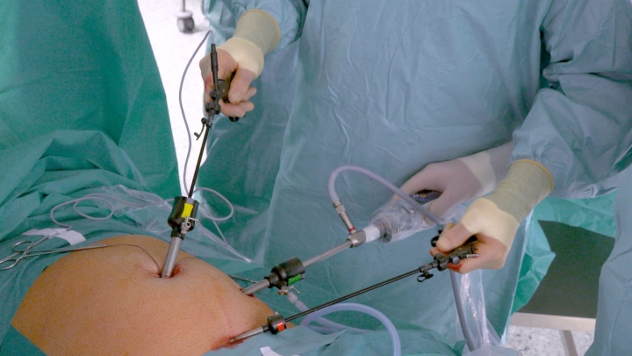 Durchführung einer laparoskopischen Appendektomie