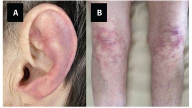 Livedo reticularis am Ohr und an den unteren Extremitäten einer 80-jährigen Frau