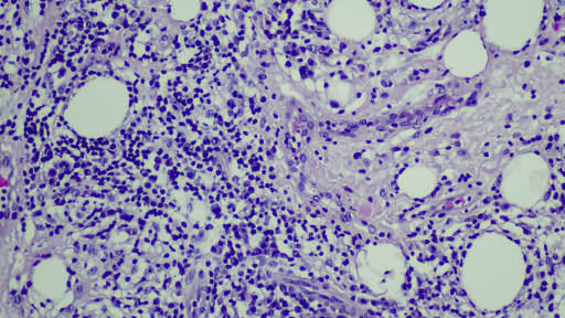 T-Zell-Klone bei kutanem T-Zell-Lymphom