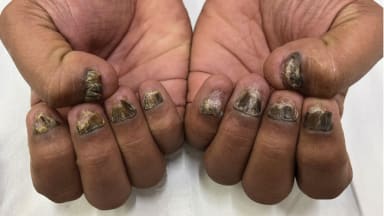 Progressive Dystrophie der Finger- und Zehennägel