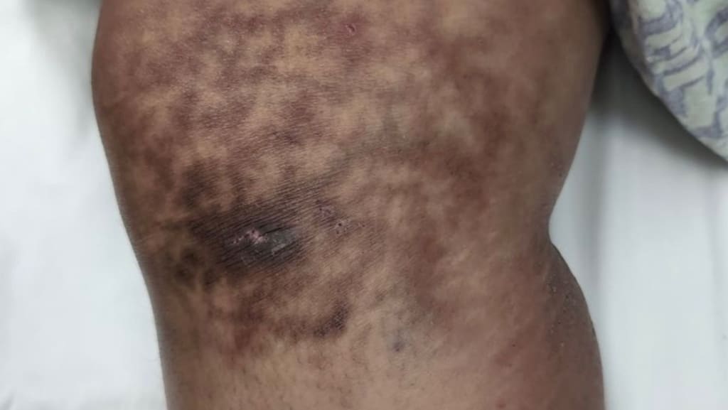 Netzartige Hyperpigmentierung am Bein