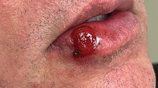 Ulkus an der Unterlippe