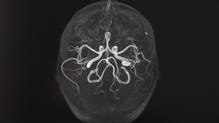 Tickende Zeitbombe intrakranielles Aneurysma betrifft Millionen
