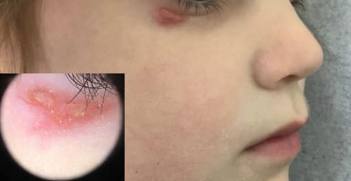 Schmerzloser Knoten am unteren Augenlid 