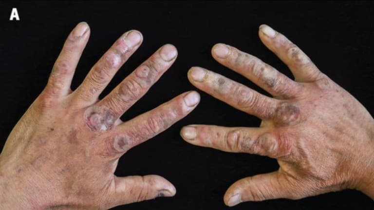 Blasen auf dunkelroten erythematösen Flecken auf dem Handrücken und den Handflächen beider Hände eines 57-jährigen Mannes