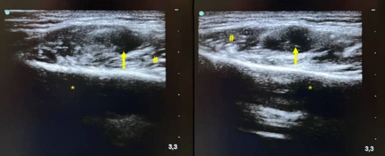 Kontinuierliche intraoperative B‑Bild-Sonographie mit Darstellung der Raumforderung