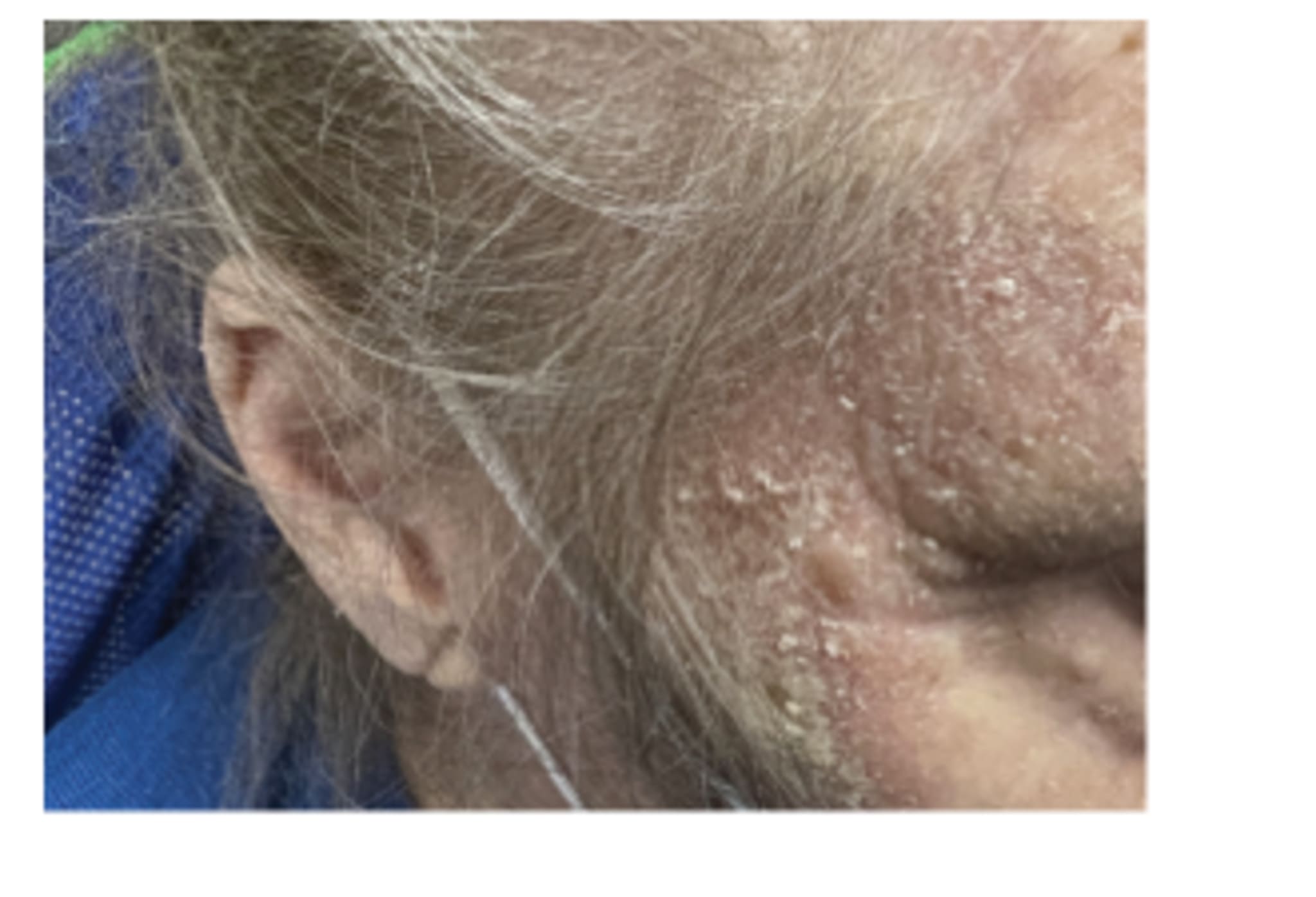 Hautabschürfungen, die an braunen Zucker erinnern