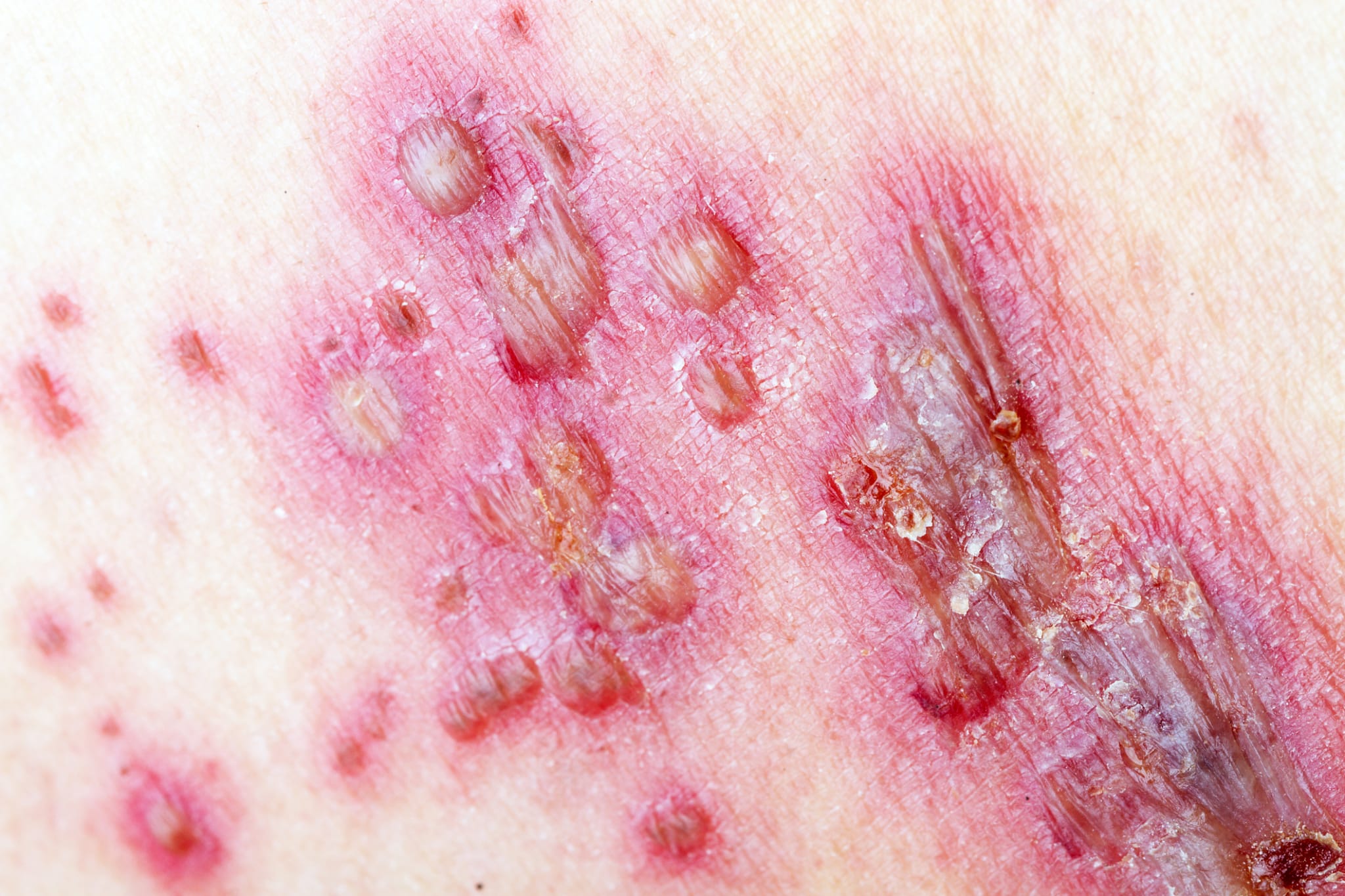 Herpes Zoster Ein Update F r Internisten