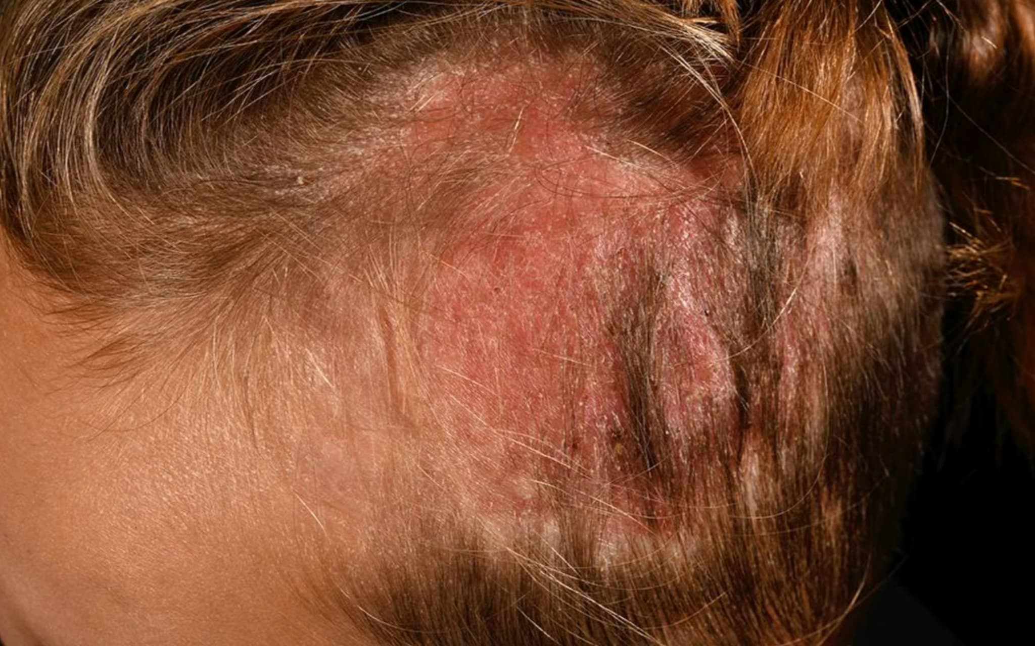 Tinea barbae profunda durch Arthroderma benhamiae