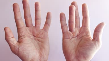 Fibroseerkrankungen der Hand