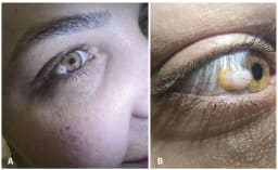 26-Jährige mit behaartem Knötchen im Auge