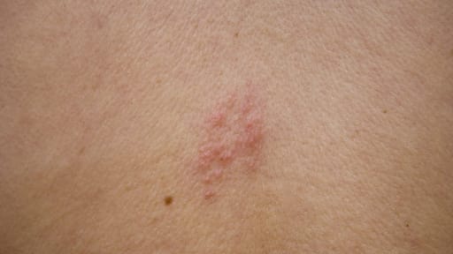Herpes Zoster auf dem Rücken