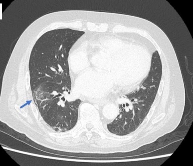 Computed tomography showed granular and interstitial shadows in the lungs