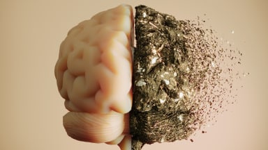 DGIM 2026: Studie zu Lithiumcarbonat bei Alzheimer-Demenz negativ