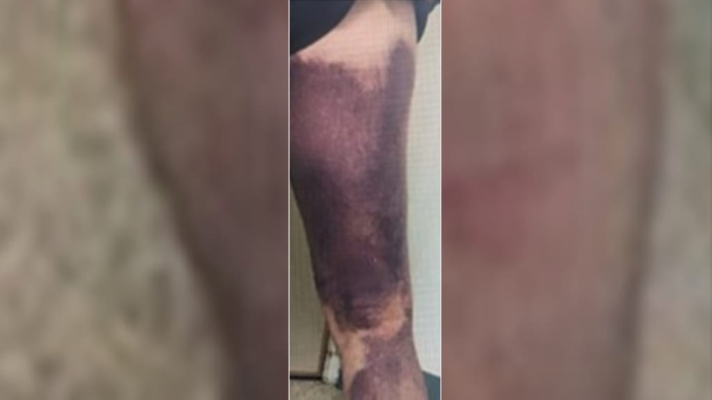 Spontanes, großflächiges Hämatom am Oberschenkel