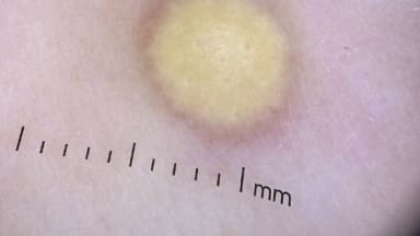 Gelbe Papel auf dem Rücken eines Säuglings Abb. 1