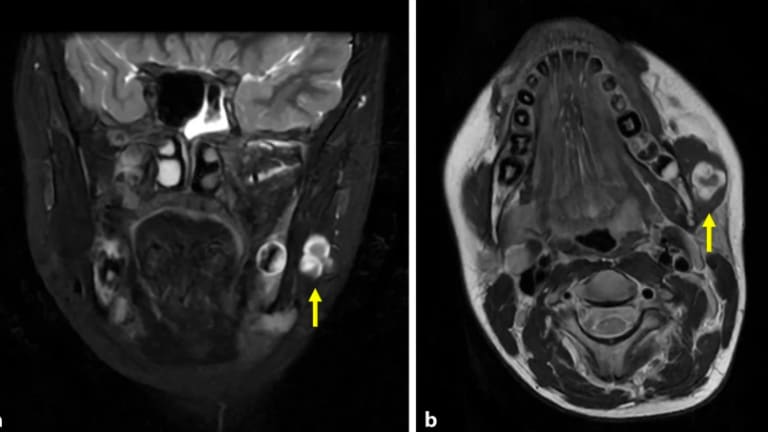 Natives Kopf-Hals-Magnetresonanztomogramm 