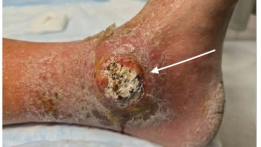 Erhabene, rundliche, ulzerierende Läsion mit kreideartigem Zentrum und umgebendem Erythem