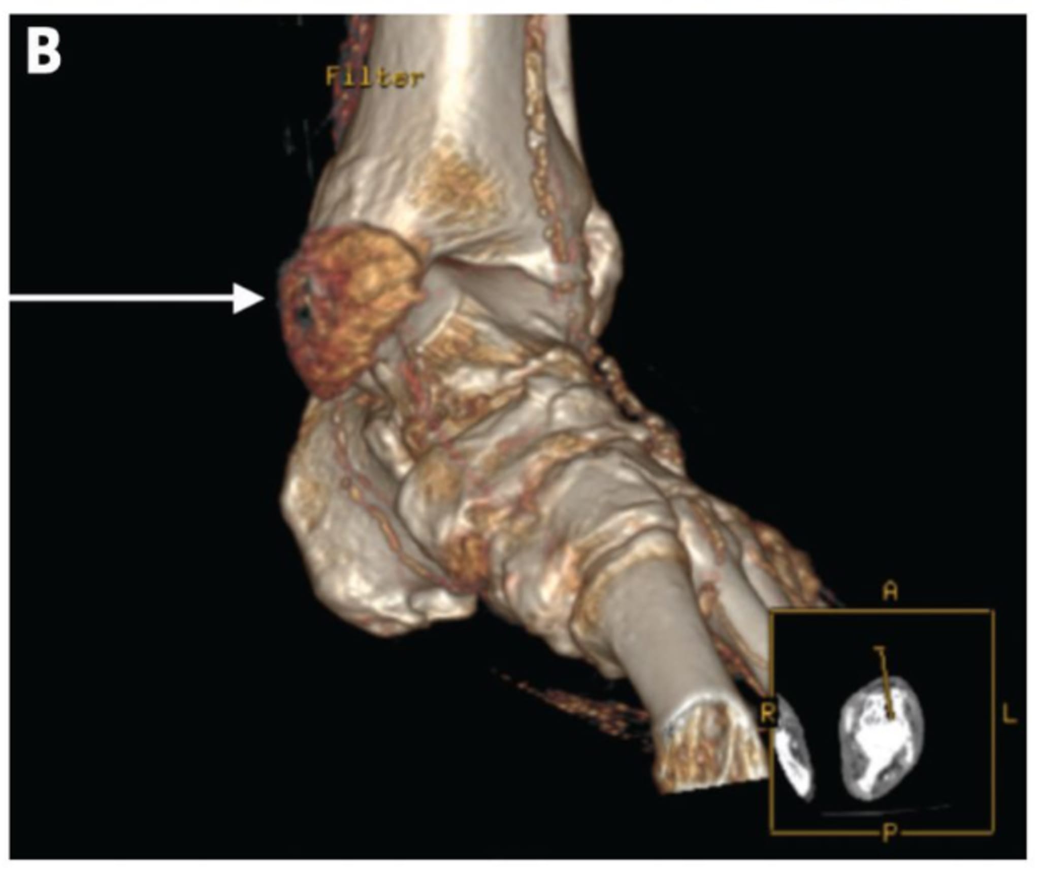 Eine Computertomographie mit Kontrastmittel zeigte einen hyperdensen mineralisierten Tophus an der Innenseite des Sprunggelenks, Hinweise auf Kristallablagerungen im Sprunggelenk, Mittelfuß und Großzeh, jedoch keine Anzeichen einer Osteomyelitis. 