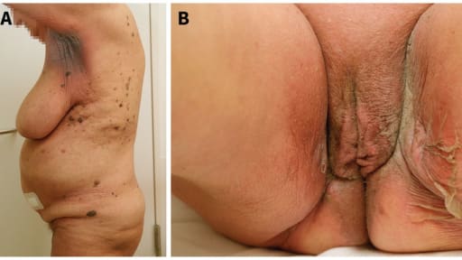 Krebspatientin mit brennendem Ausschlag auf 10% der Körperoberfläche