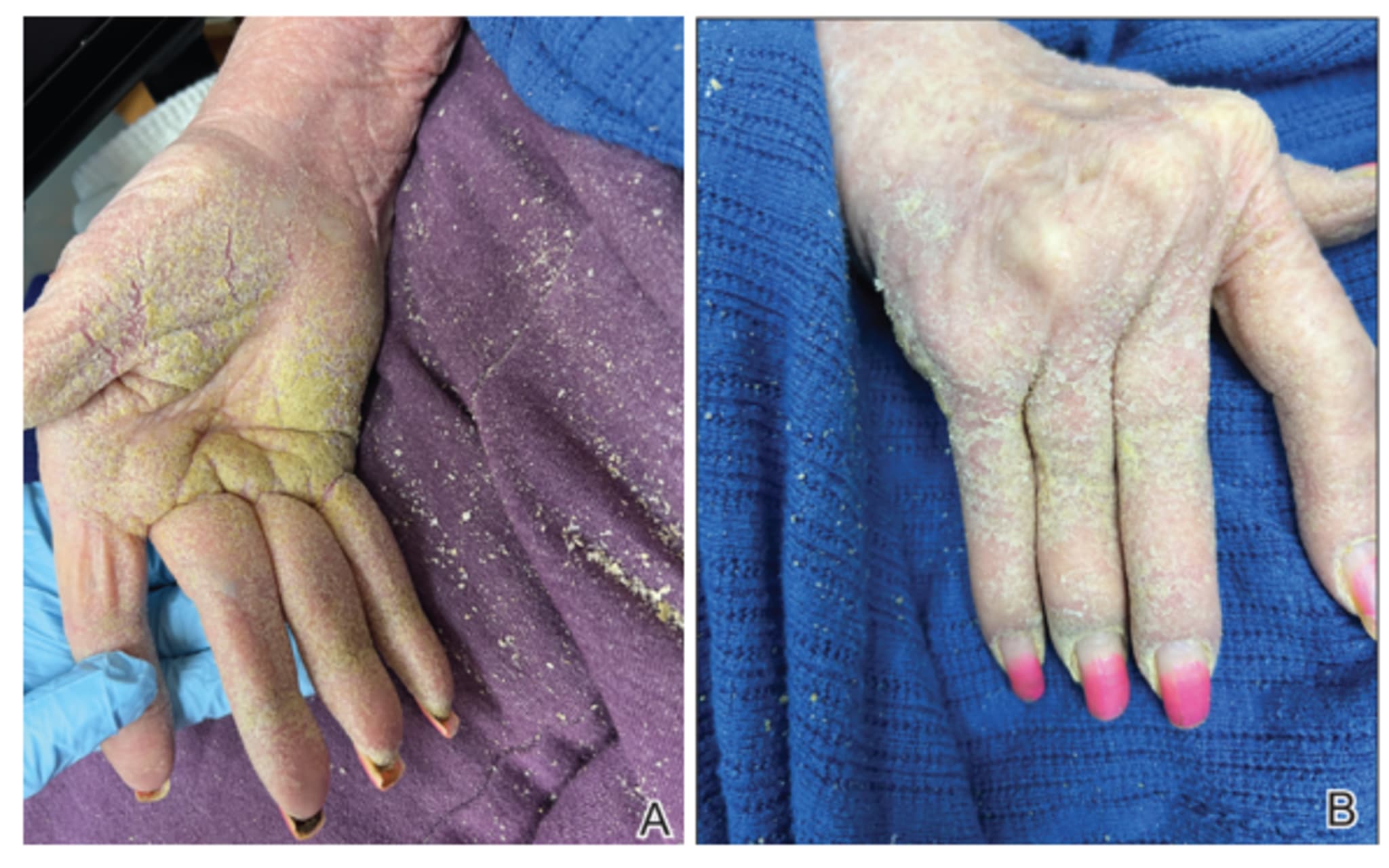 Hautabschürfungen, die an braunen Zucker erinnern