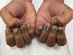 Progressive Dystrophie der Finger- und Zehennägel