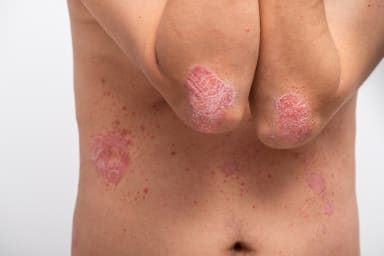 Biologika bei Psoriasis: Wann ein Wechsel sinnvoll ist