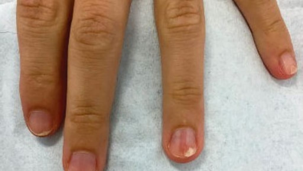 Schmerzempfindlicher Fingernagel mit roter Linie