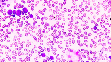 Akute myeloische Leukämie (AML), eine Form von Blutkrebs, bei der das Knochenmark abnormale Myeloblasten bildet.
