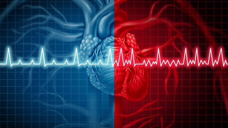 Hybrid-Ablation gegen Vorhofflimmern