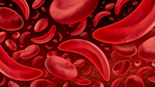 Neue Gentherapie von Thalassämie & Sichelzellkrankheit 